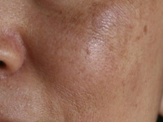 Nám mảng -  Dấu hiệu và cách trị hiệu quả